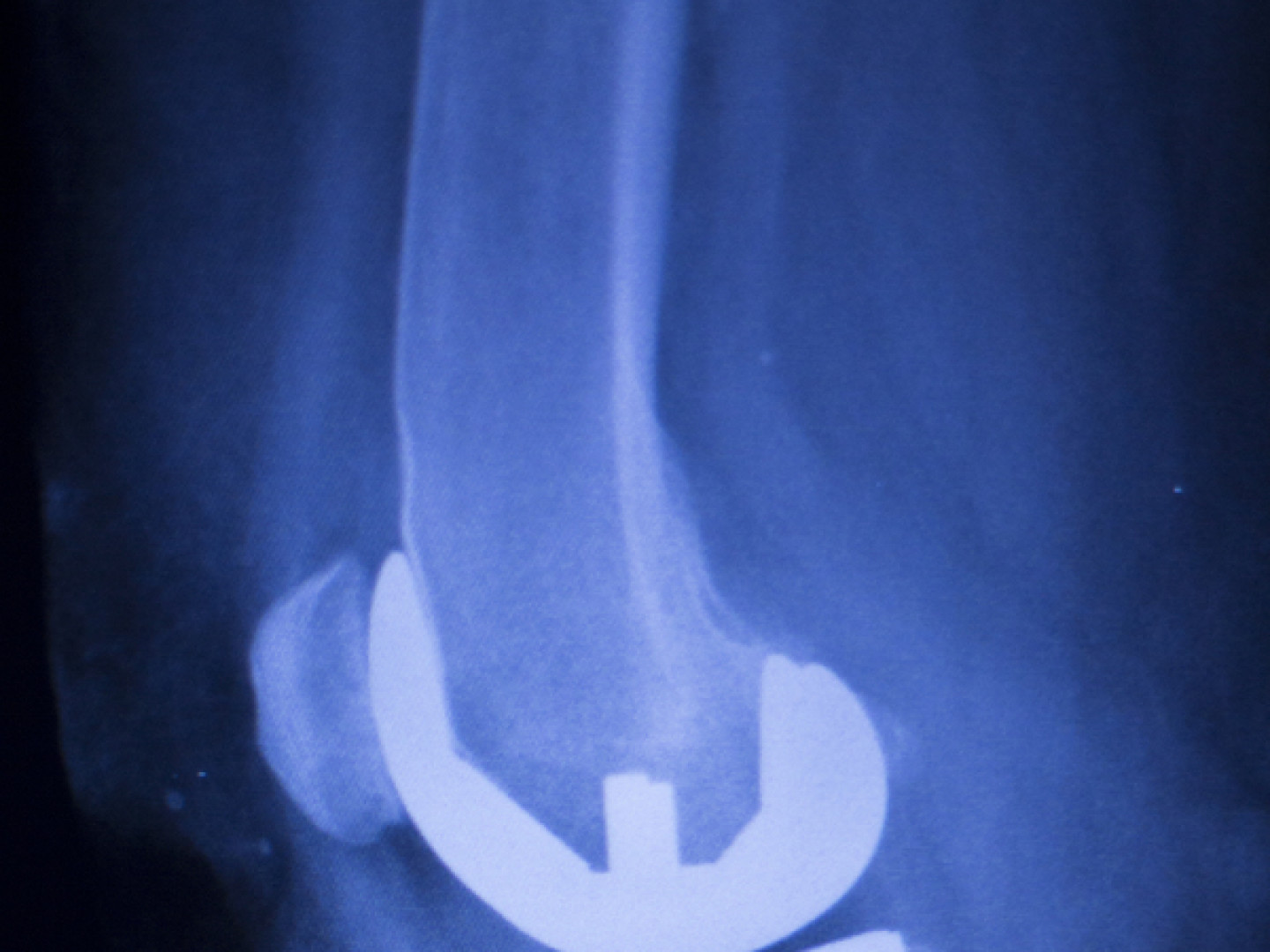 Total Joint Replacement Therapy Waterville, ME Orthopedic Physical